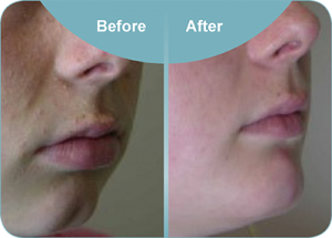 cleft chin removal before and after