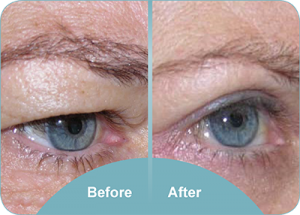 inner eyelid surgery