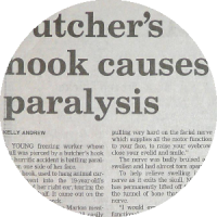 Facial nerve skull surgery media article