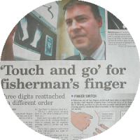 Fingers reattached leeches media article