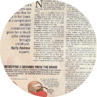 Nasal dermoid surgery media article