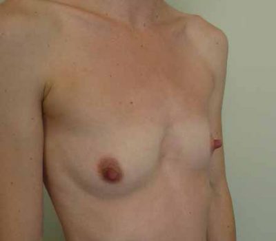 aa25