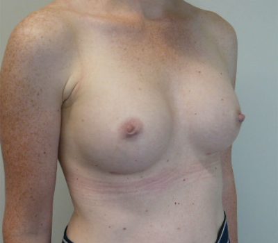 inverted-nipple-new-zealand-2