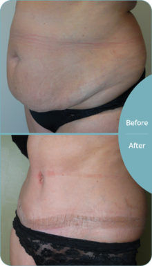Abdominoplasty-1