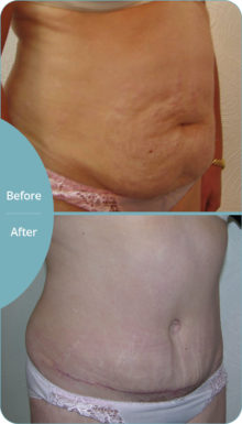 Abdominoplasty before and after
