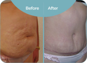 Abdominoplasty before and after