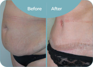 Abdominoplasty before and after